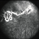 Late-phase fluorescein angiograph showing staining  of old laser scars in an area of peripheral retinal nonperfusion